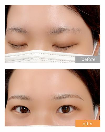 アートメイク症例