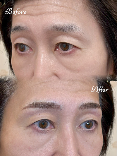 アートメイク症例