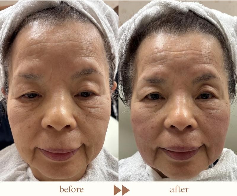 ボルニューマ症例