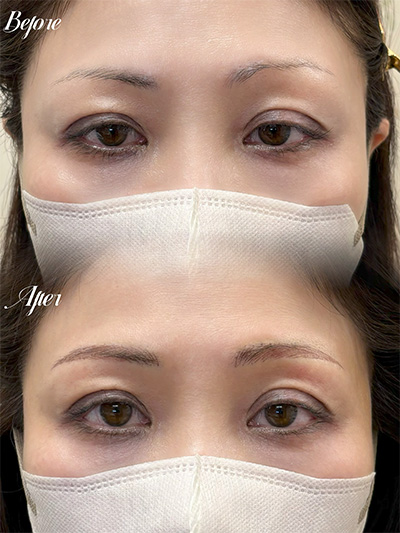 アートメイク症例