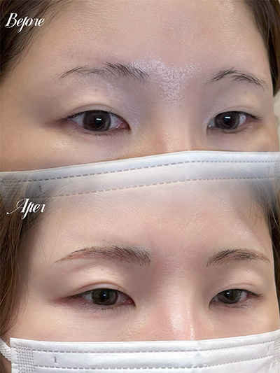 アートメイク症例