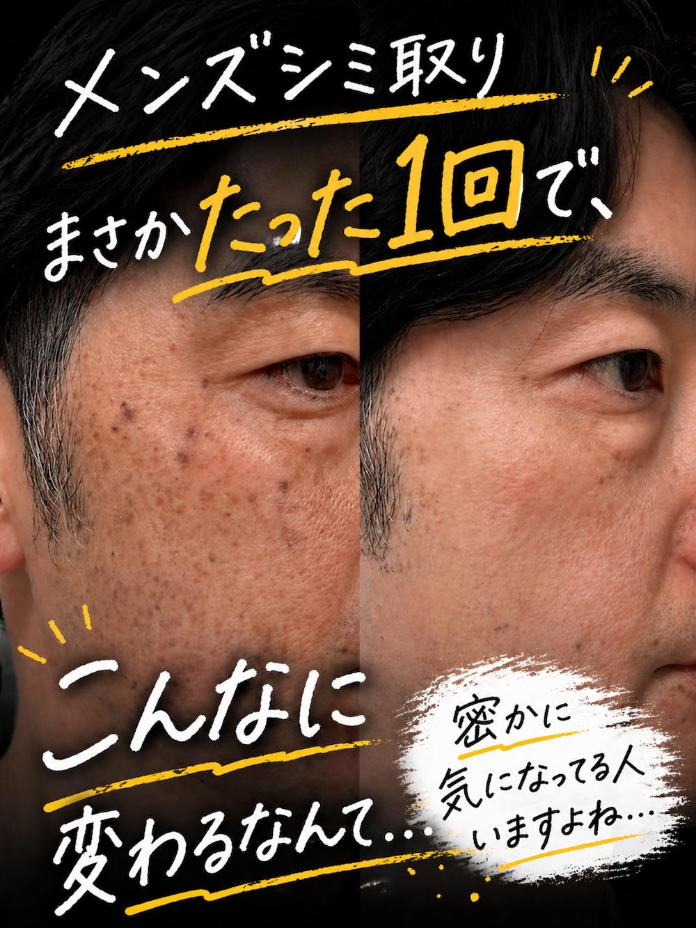 アートメイク症例