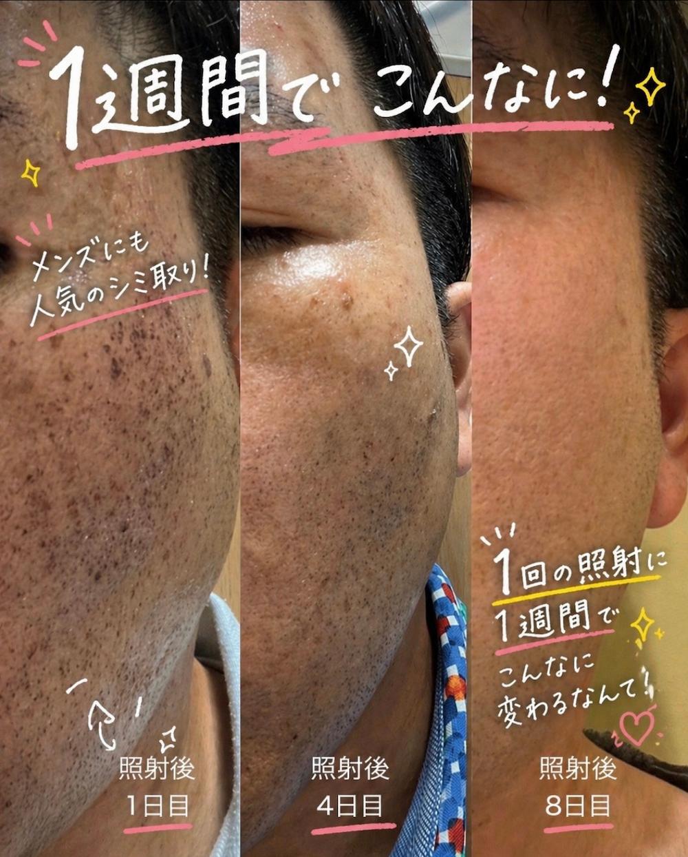 アートメイク症例